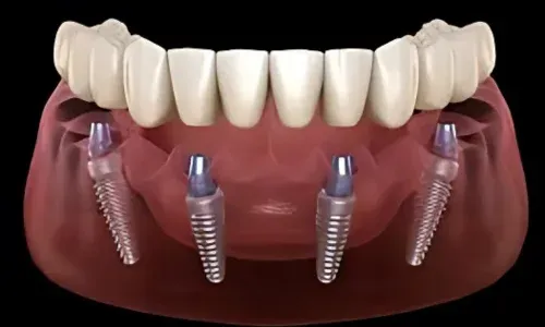 All-on-4-Implants