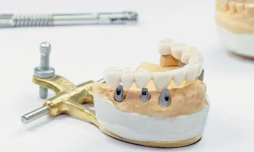 Multiple-Tooth-Implants