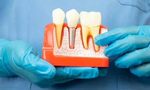 Single-Tooth-Implants