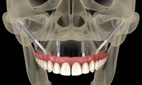 Zygomatic-Implants