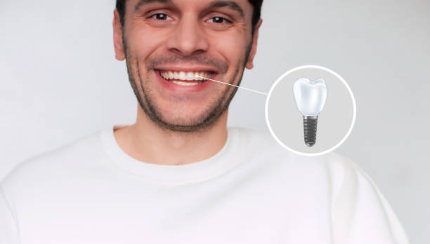 dental-implants-and-their-benefits
