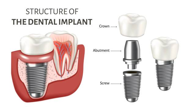 Dental-Implant-procedures