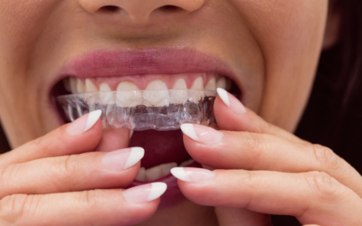 Invisalign-Express