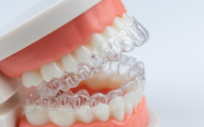 Invisalign-Full