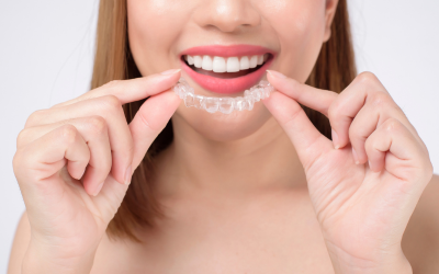 Invisalign-Lite