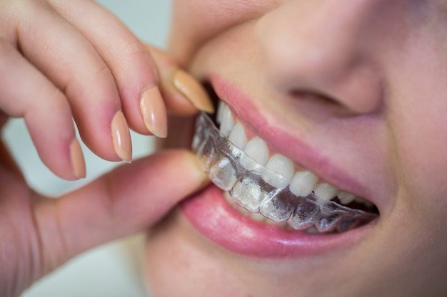 Post-Invisalign-Care