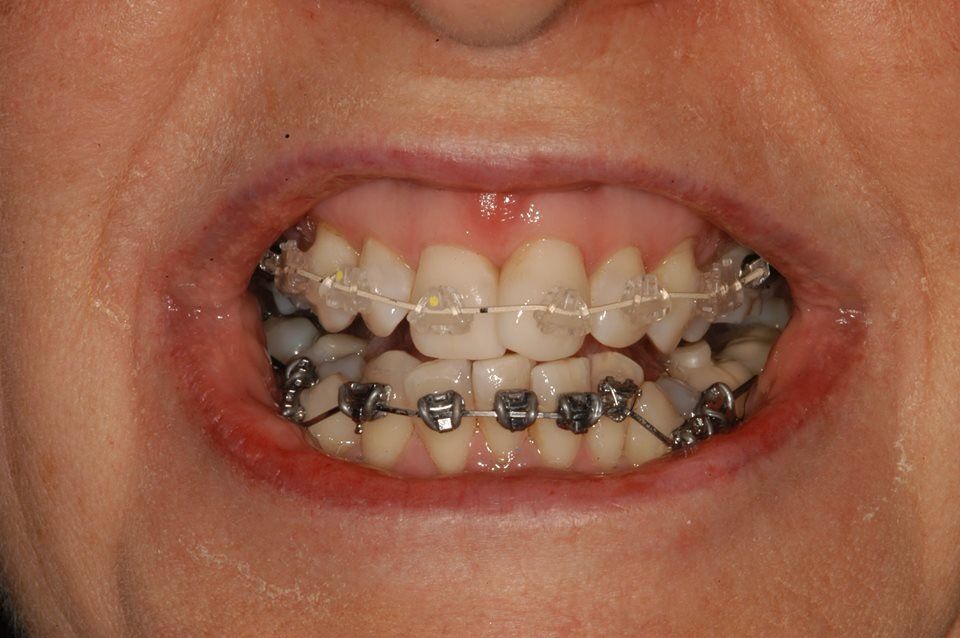 Addressing Severely Crowded Teeth with Orthodontic Braces - navadiadentalclinic Close-up of a patient's crowded lower teeth with metal braces and clear ceramic braces on the upper teeth, demonstrating orthodontic intervention for severe dental crowding.