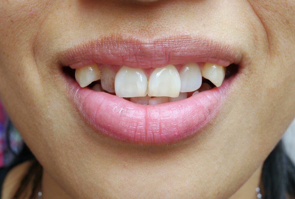 Common Braces Problems and Solutions Most Common Dental Problems That Braces Can Fix Easily teeth problem solution with braces - navadiadentalclinic A close-up view of a smile where the side teeth angle inward, clearly showing a bad bite (malocclusion) that requires orthodontic treatment to correct.