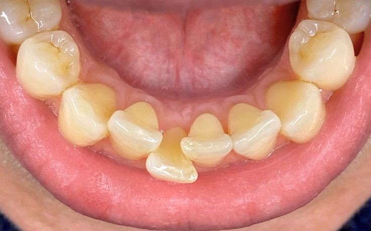 Most Common Dental Problems That Braces Can Fix Easily teeth problem solution with braces braces for correcting bite braces for overbite straight teeth braces why braces are used - navadiadentalclinic An overhead view of a patient's severely crowded and crooked lower teeth before braces, illustrating a condition that makes proper cleaning difficult and increases the risk of tooth decay.