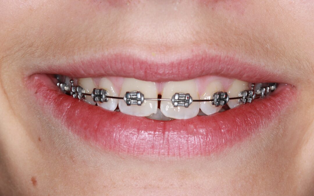 Are Braces Just for Looks?