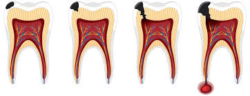 images 2 - navadiadentalclinic how to stop tooth decay from spreading