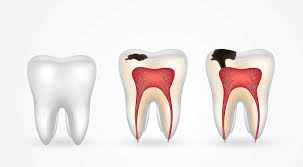 Tooth decay effects on general health - navadiadentalclinic what is tooth decay how can you prevent it and what is tooth decay how it is caused